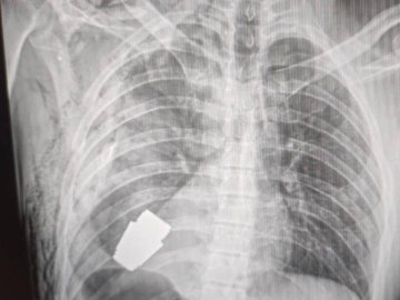 Героїчна операція: з тіла військовослужбовця дістали гранату, яка не розірвалася