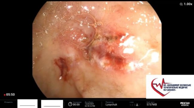 Волинські лікарі витягнули «з того світу» жінку з критичною кровотечею 