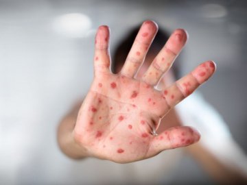 За останній тиждень на Волині – сотня хворих на кір. ФОТО