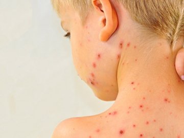 Волинян закликають вакцинуватися від кору