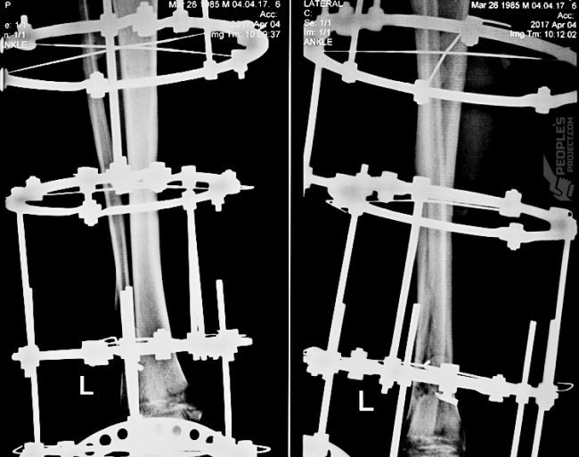 Терміново прооперували волинського бійця, який підірвався на розтяжці