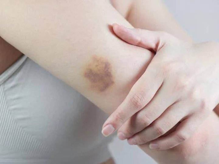 Луцька лікарка розповіла, коли після появи синців на тілі треба бігти в лікарню