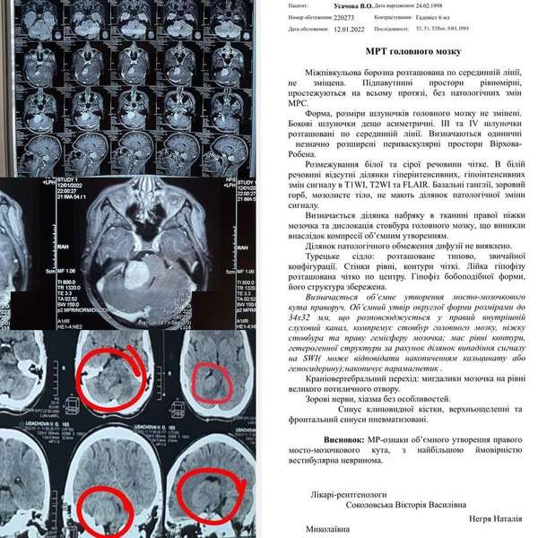 У 23-річної лучанки виявили пухлину головного мозку