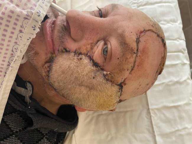 У Луцьку лікарі провели унікальну операцію на обличчі. ФОТО