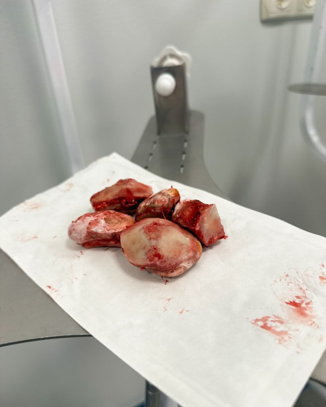 Волинські медики видалили пацієнту із сечового міхура 5 великих каменів. ФОТО