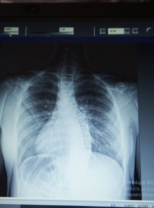 Хвороба швидко прогресує: дівчині з Волині потрібна дороговартісна операція