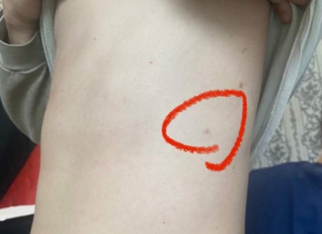 Український військовий три тижні воював з уламком снаряда в хребті. ФОТО