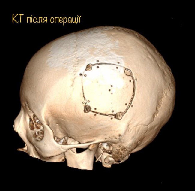 Була у свідомості: 16-річній дівчині провели складну операцію на головному мозку. ФОТО