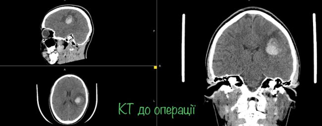 Була у свідомості: 16-річній дівчині провели складну операцію на головному мозку. ФОТО
