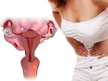 Ендометріоз як одна з причин безпліддя: особливості хвороби, причини розвитку, лікування*