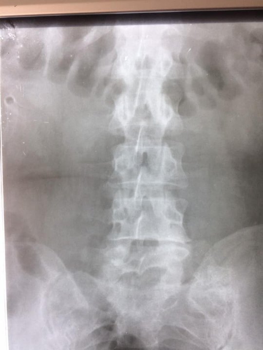 Волинські лікарі видалили пацієнтці великий камінь нирки через маленький розріз шкіри. ФОТО