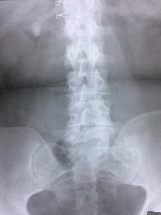 Волинські лікарі видалили пацієнтці великий камінь нирки через маленький розріз шкіри. ФОТО