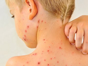 У Луцьку – друга хвиля спалаху кору. ВІДЕО