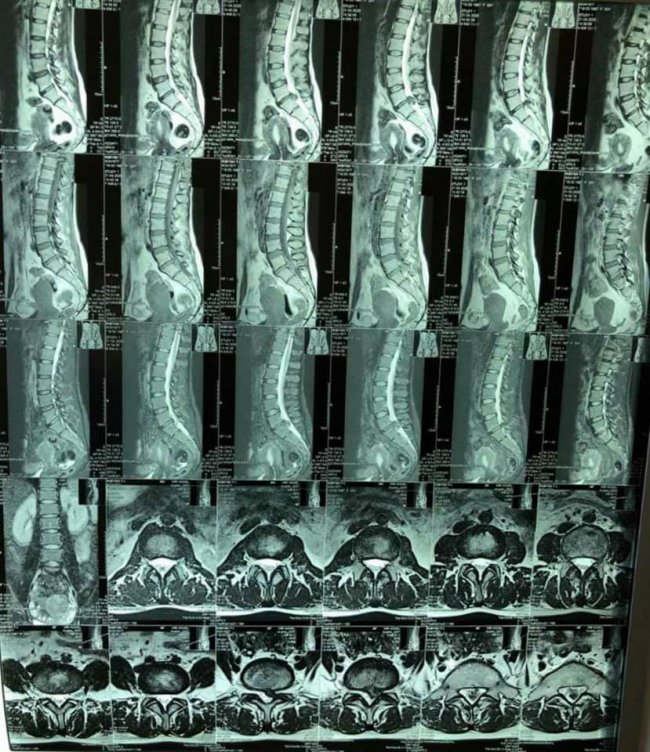 Зберегли можливість ходити: волинські лікарі повернули жінку до повноцінного життя. ФОТО