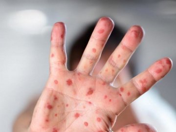 Лише в одному районі Волині – жодного випадку кору