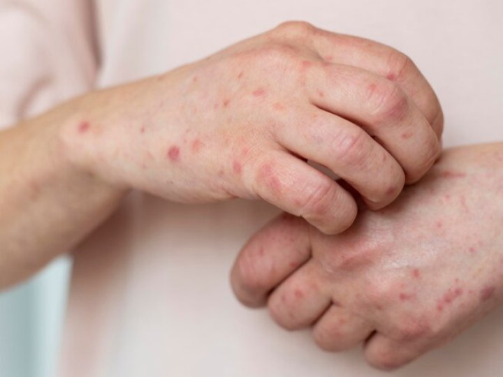 В Україні фіксують зростання захворюваності на вітрянку: яка ситуація на Волині