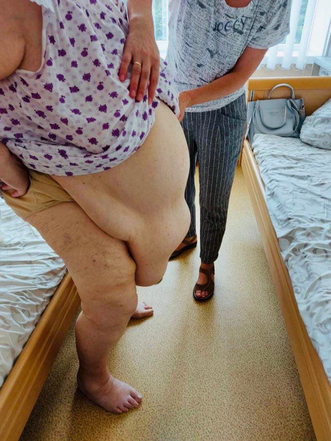 Луцькі хірурги видалили з живота жінки 15 кг жиру та шкіри.ФОТО