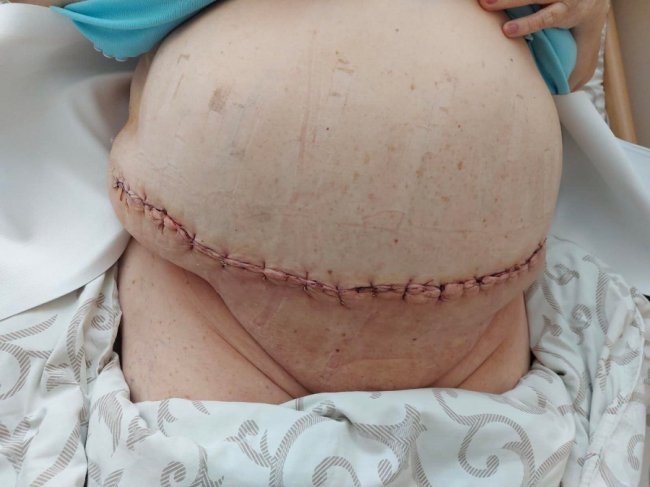 Луцькі хірурги видалили з живота жінки 15 кг жиру та шкіри.ФОТО