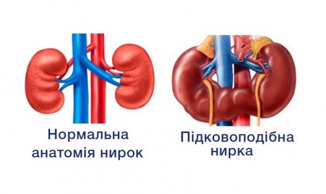 Волинські медики провели унікальну операцію 17-річній дівчині, в якої зрослися нирки