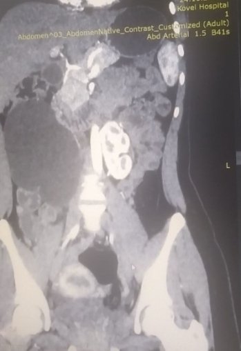 Волинські медики провели унікальну операцію 17-річній дівчині, в якої зрослися нирки