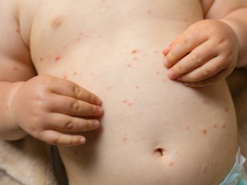 Вітрянка: відповіді на поширені запитання про цю хворобу від луцької лікарки