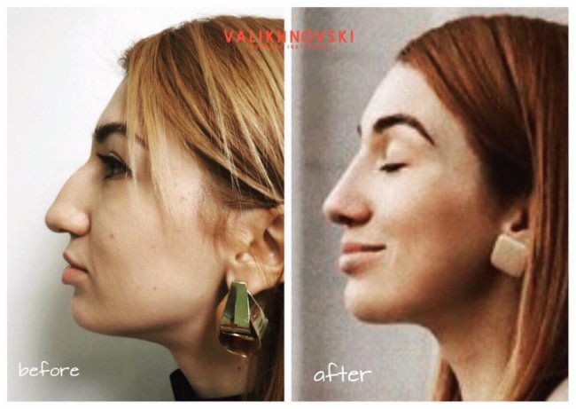 Хірург з Волині Валіхновський показав результати після оперування відомої блогерки