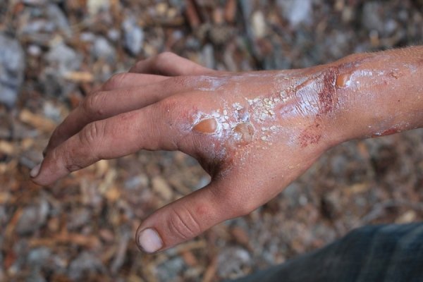 Опіки від неопалимої купини