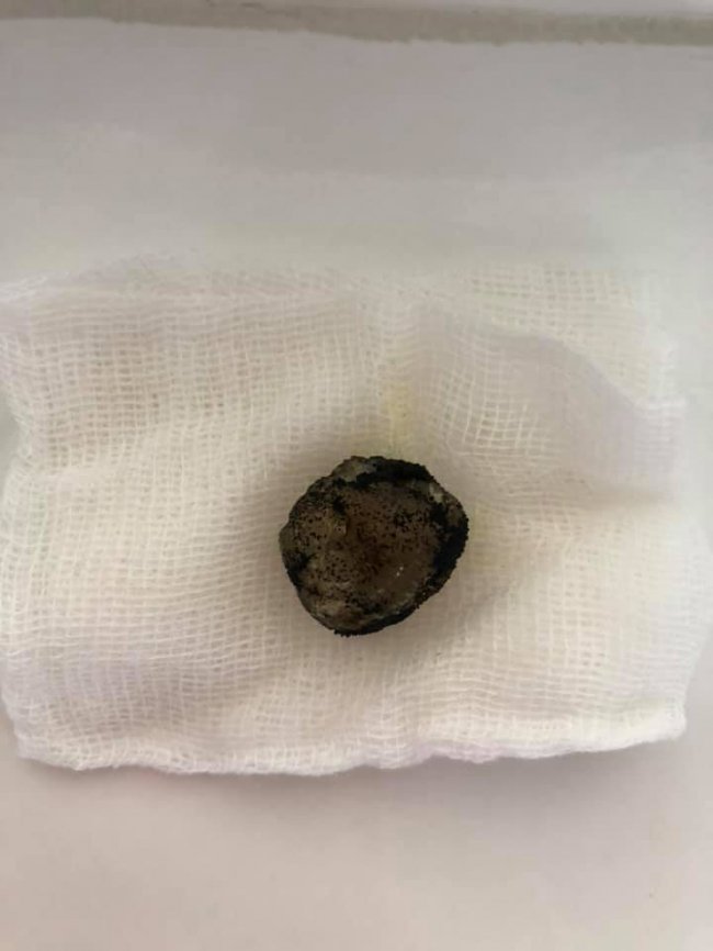 Волинський лікар видалив чималий камінь із жовчного пацієнта без розрізів 