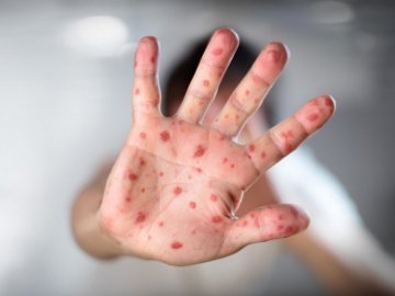 Кір на Волині: найбільше хворих у Ковелі