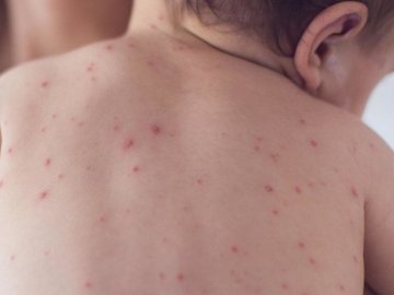 Кір продовжує «косити» волинян