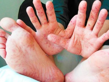 Савченко боїться «навали» кору на Волинь