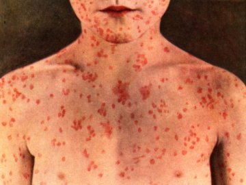 У Луцьку хворі на кір змушені чекати на прийом лікаря в загальній черзі, – соцмережі