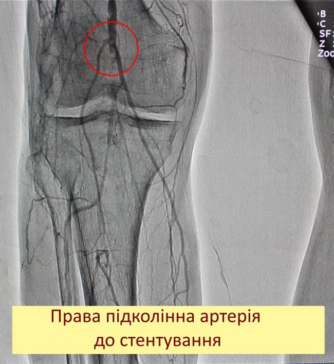 Ковельські хірурги врятували чоловікові ногу від ампутації 