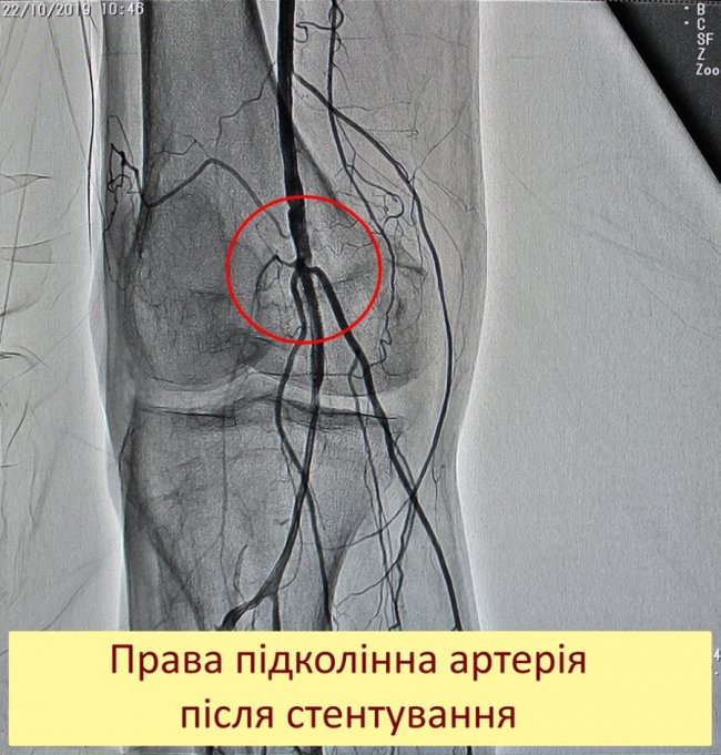 Ковельські хірурги врятували чоловікові ногу від ампутації 