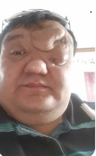 Відомий хірург з Волині прооперував чоловіка з пухлиною на обличчі. ФОТО