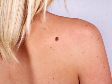 У Маневичах безкоштовно обстежуватимуть на рак шкіри