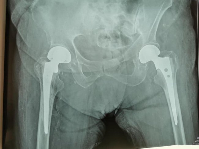 У луцькій лікарні 95-річній жінці замінили суглоби. ФОТО