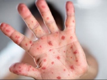 У Львові від кору помер нещеплений 2-річний хлопчик