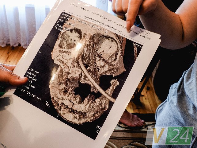 Знімок черепа Іванки після першої операції