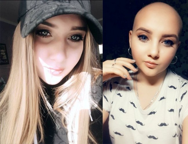 «Шампунь по акції купила»: юна онкохвора волинянка про втрату волосся після хіміотерапії. ФОТО