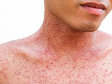 Кір на Волині: більше стали хворіти дорослі. ВІДЕО