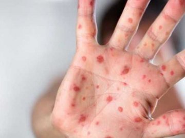 У районі на Волині – новий спалах кору