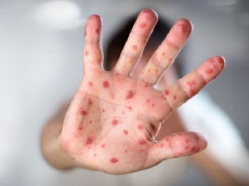 На Волині – нові випадки кору