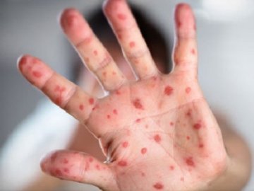 У Нововолинську на кір захворіло 30 дітей