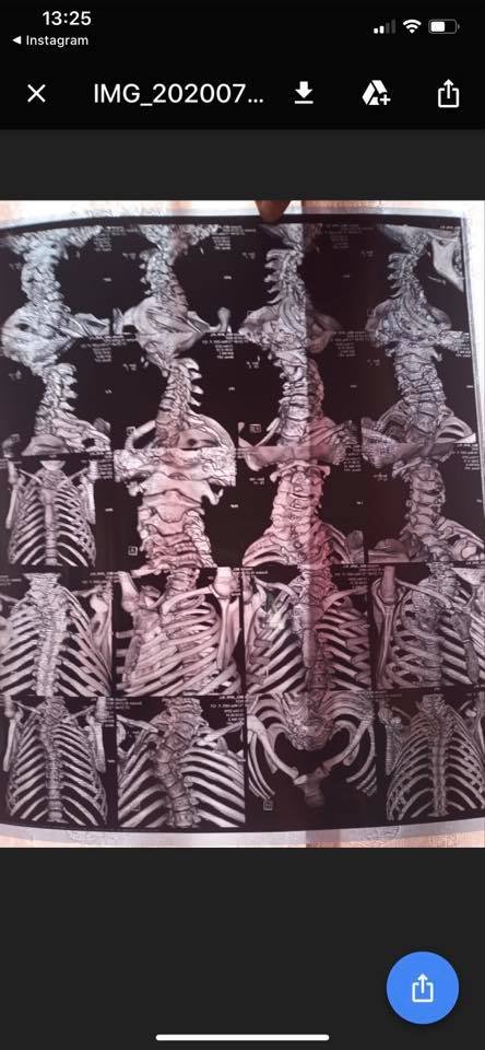 Терміново потрібна допомога доньці воїна 51 ОМБр