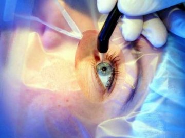 Як підготуватися до лазерної корекції зору?*