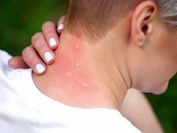 Двоє волинянок захворіли на дирофіляріоз