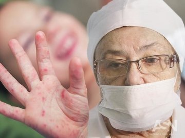 У Луцьку за останній тиждень на кір захворіло 35 людей