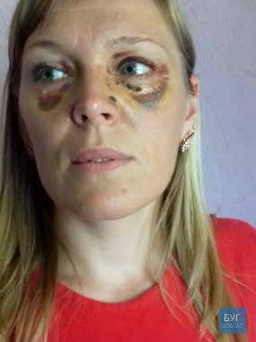 «Аліментів захотіла?» - на Волині чоловік побив колишню дружину. ФОТО. ВІДЕО. 18+