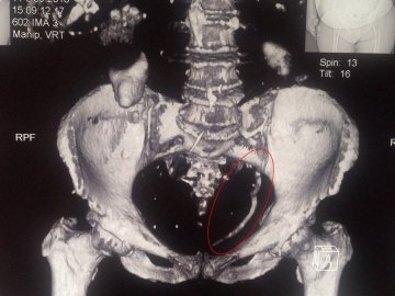 Медики роздробили гігантський камінь у сечоводі волинянки